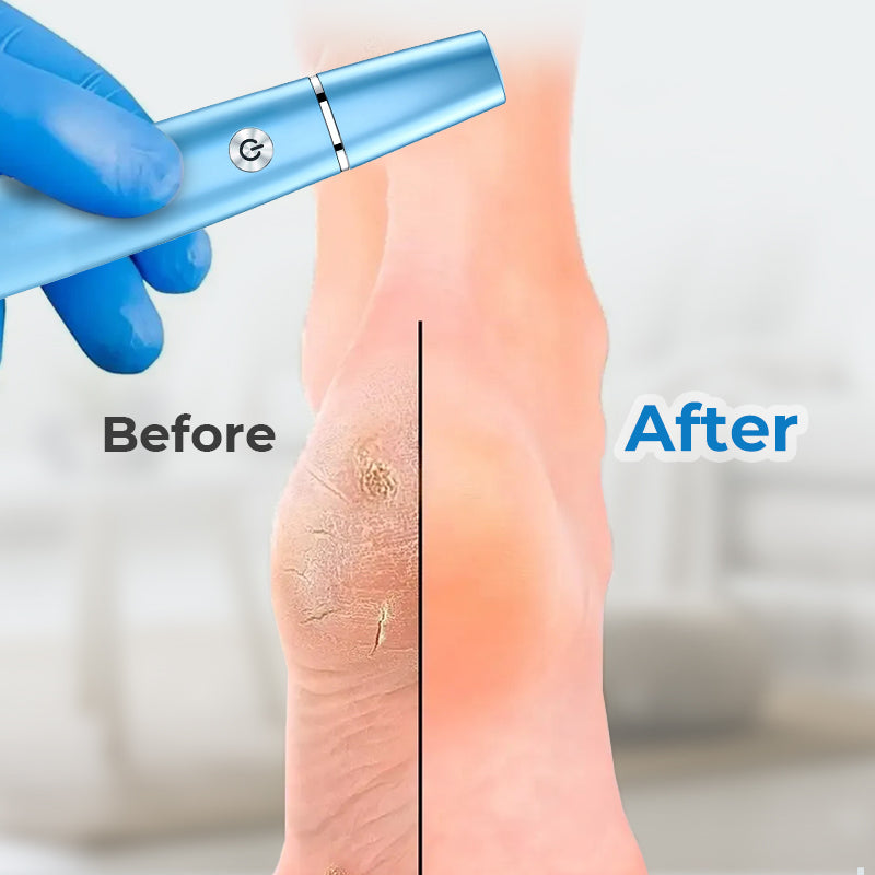 🔥Hot Sale - 50% OFF🔥Electric Feet Callus Remover⚡